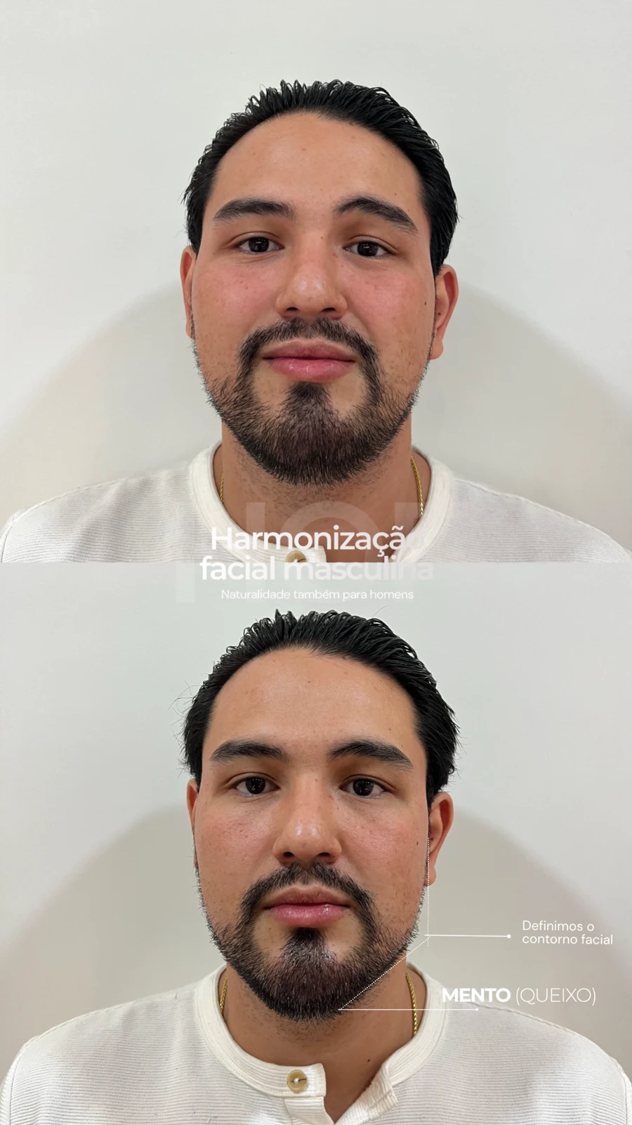 Antes e depois de harmonização facial masculina na TriSeé