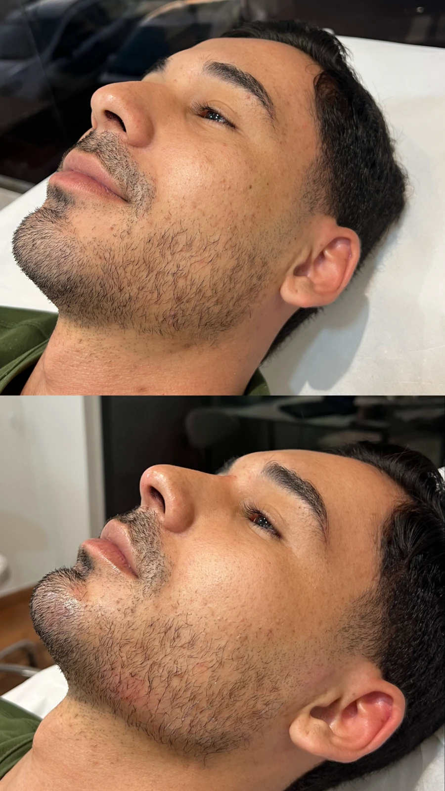 Antes e depois de tratamento de papada na TriSeé